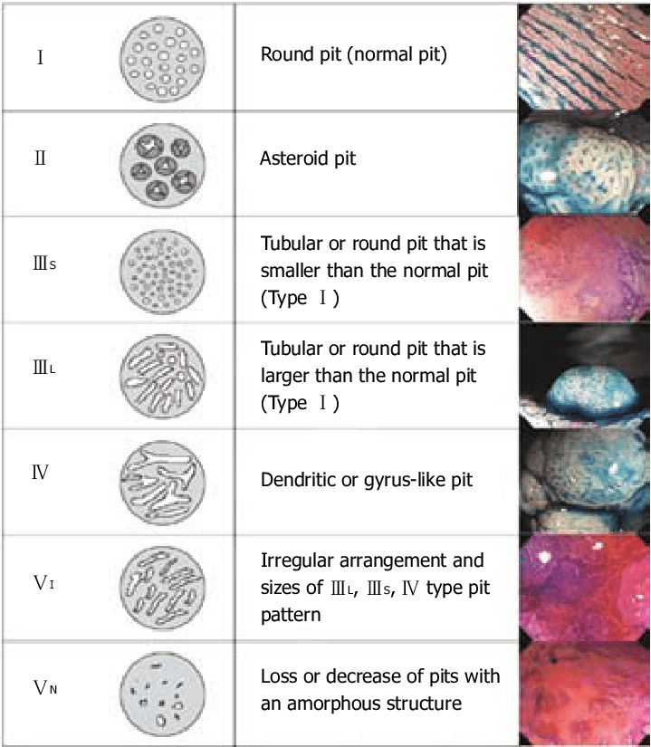 Kudo pit pattern classification, types I to Vn, with endoscopic images