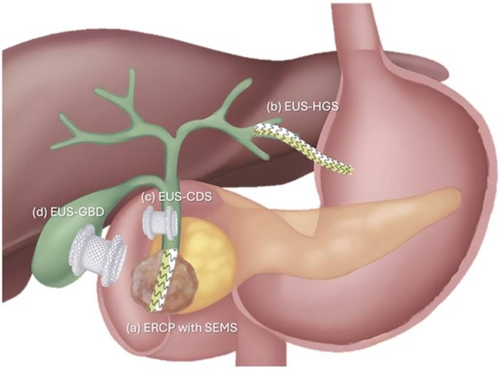 Illustration of EUS-guided biliary drainage routes labelled EUS-HGS, EUS-CDS and EUS-GBD