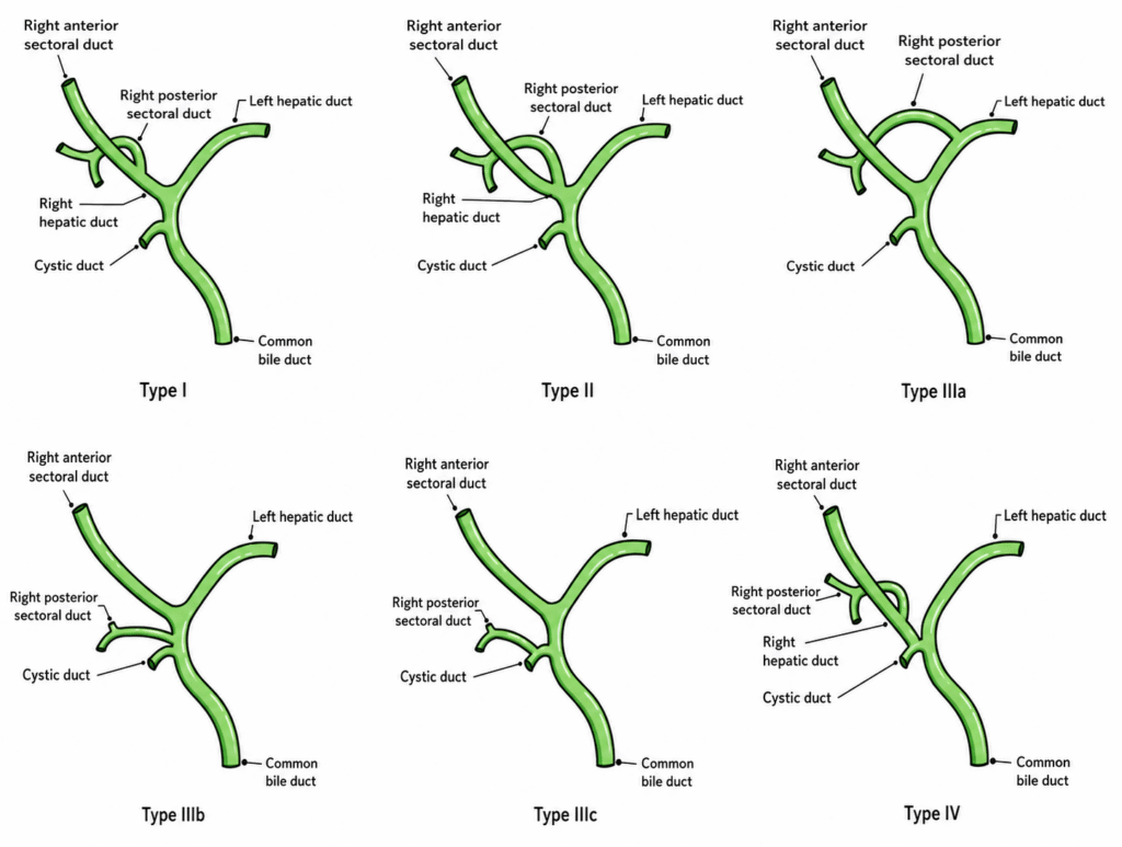 Diagrams of biliary anatomy variants, types I to IV